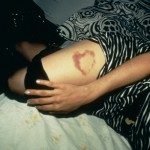 Heart-shaped bruise, NYC 1980